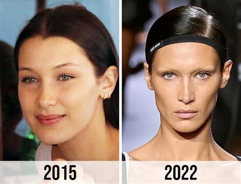 bella hadid buccal fat removal|Bella Hadid plastic surgery: Before and after 